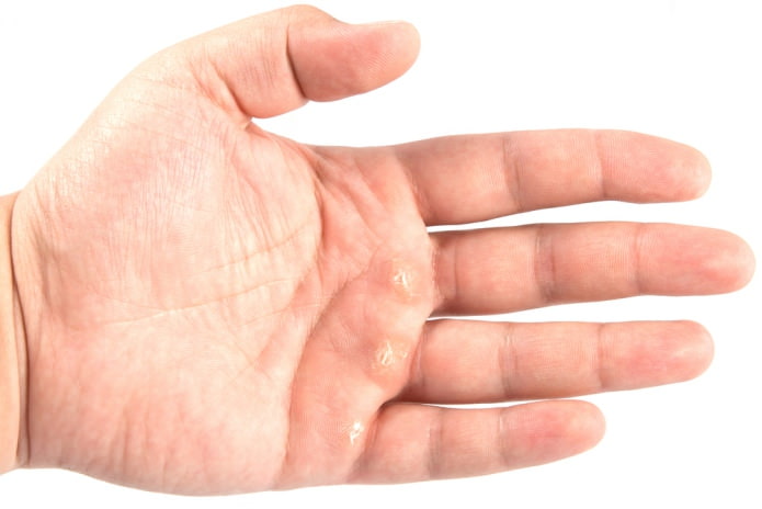 Рабочие способы борьбы с мозолями на пальцах рук