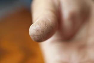Причины трещин на коже пальцах рук