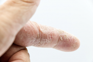 Лечение потрескавшейся кожи на пальцах рук: народные и косметические способы